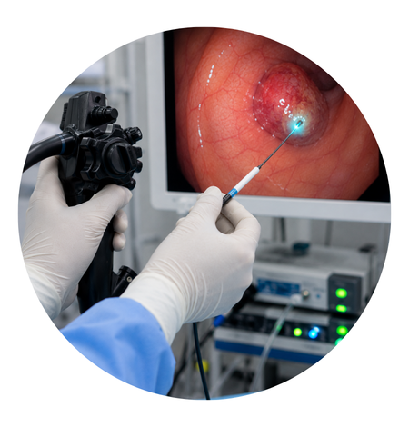 Endoscopic Thermal Ablation